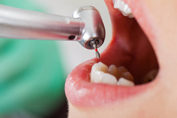 Best Emergency Wisdom Tooth Extraction in Federal Y, WA